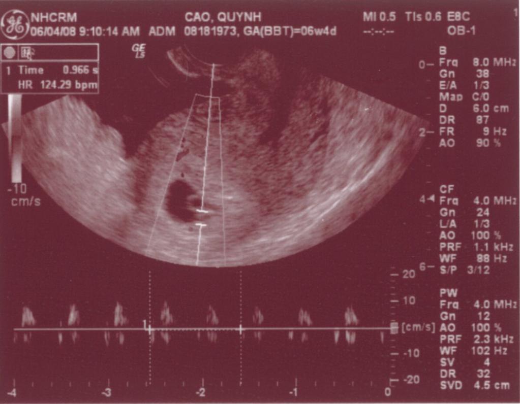 Ngày 6/4/08, lần đầu tiên Ba Mẹ nghe tim con đập, 124 nhịp/phút. Mẹ sung sướng nhìn con. Còn Ba thì rơm rớm nước mắt, hihi!! 