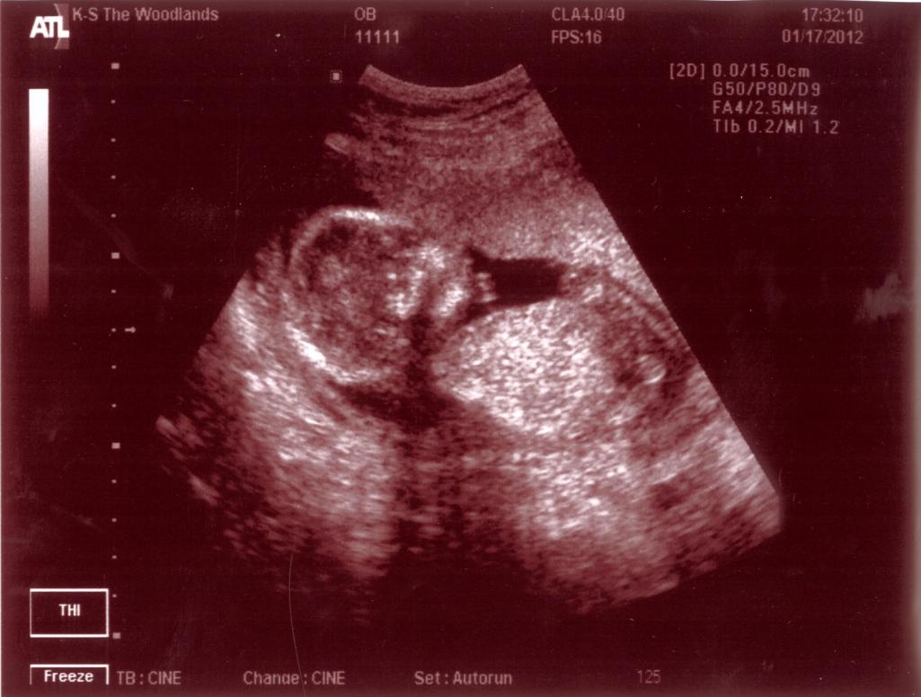 Ngày 1/17/2012, em đã có đầu mình chân tay.