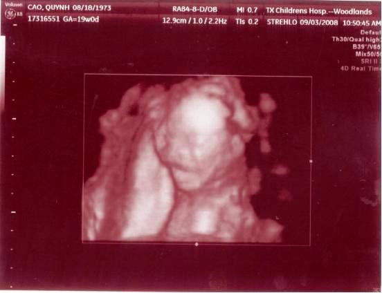 Con trai miệng bự giống Ba.  19 tuần là mắt mũi miệng đầy đủ hén.