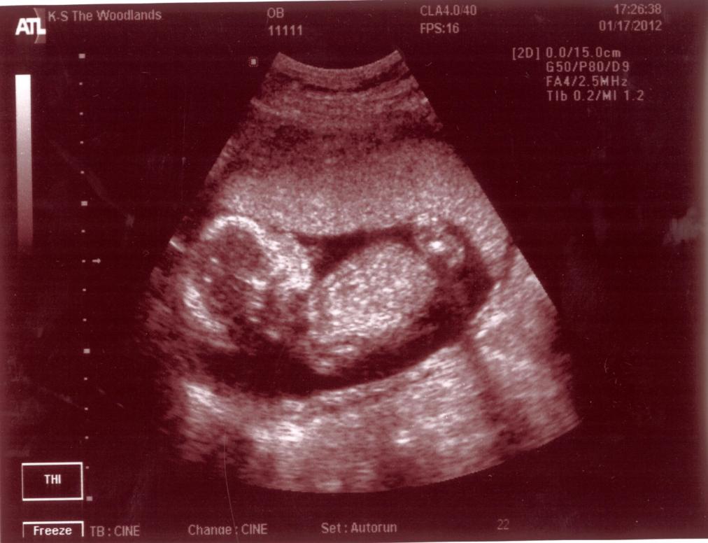 Ba Mẹ không ngờ Chúa lại cho Ba Mẹ niềm vui có em bé một lần nữa.