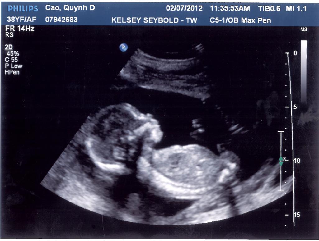 Ngày 2/7/2012 em được 0.5kg, dài 10cm, không nhào lộn nhiều như con nhưng cựa quậy rất nhiều.