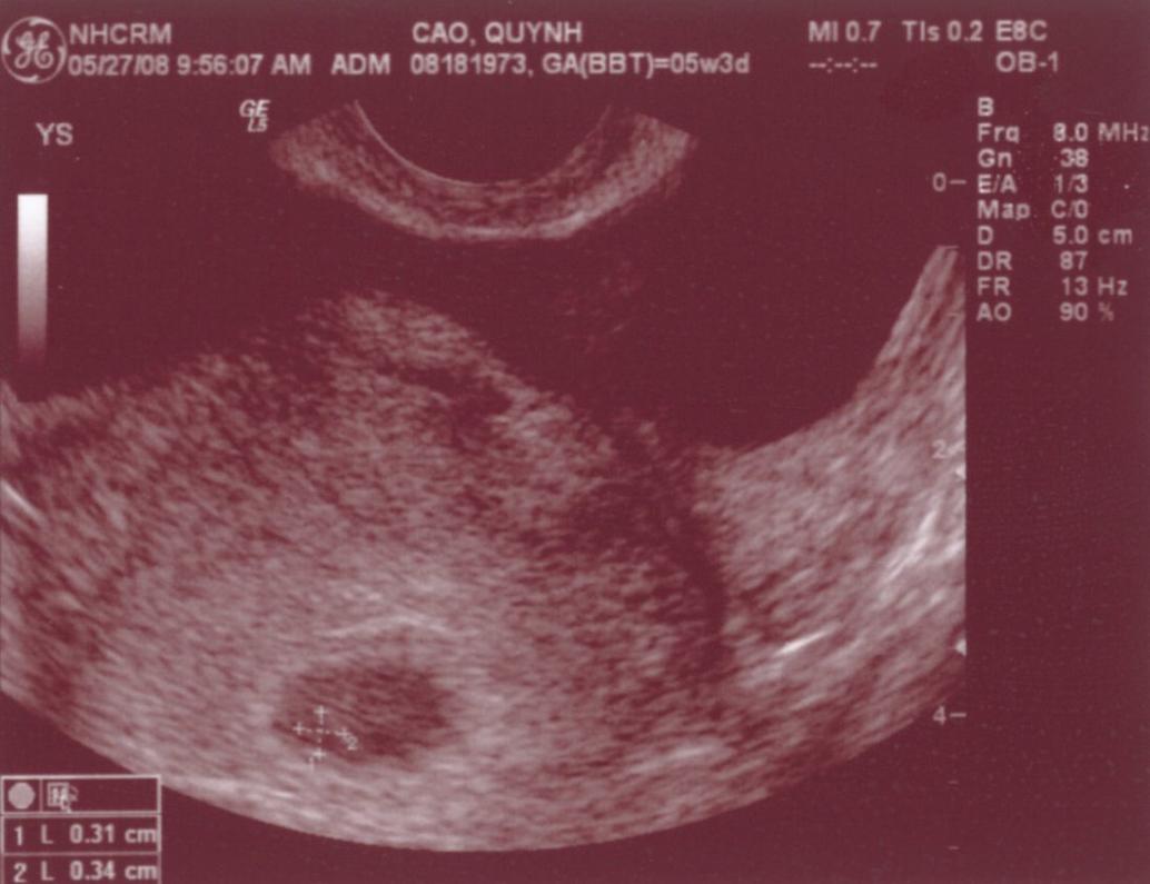 Ngày 5/27/2008, con đây rồi!!! Mới được 2 tuần, là hạt nhân nhỏ xíu trong bụng Mẹ thôi