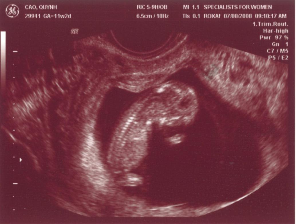 Ngày 7/8/2008, con được 11 tuần rồi, bắt đầu có tay chân rồi đây...